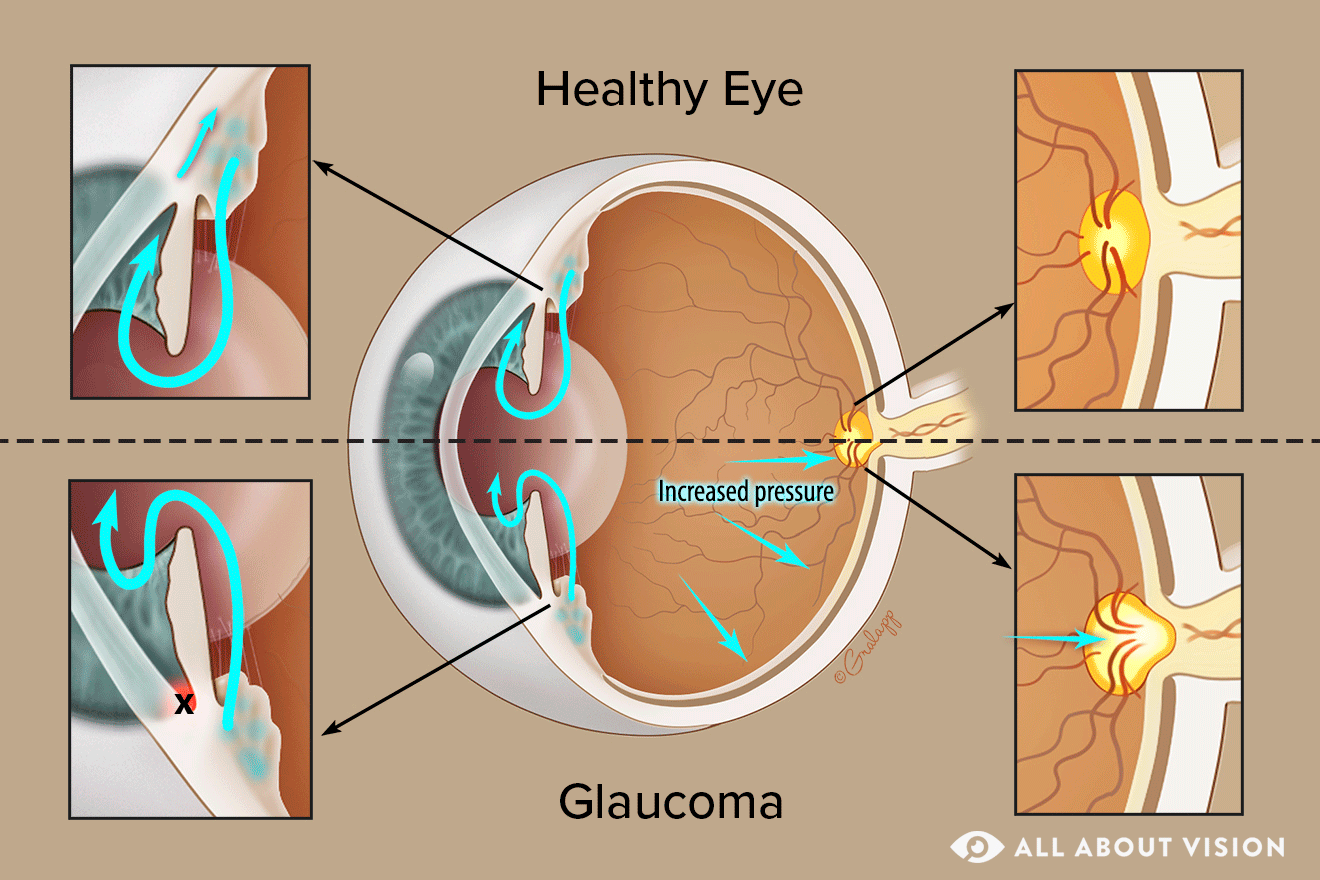 Ухо давит глаз. Глаукома режим жизни. Oct Optic Disc Glaucoma.